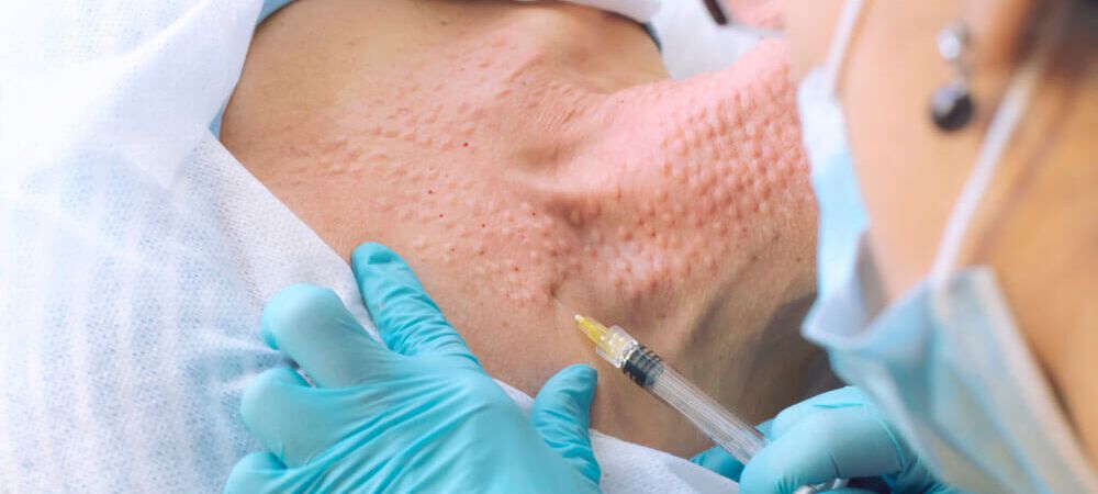 Mesotherapie Mesotherapie