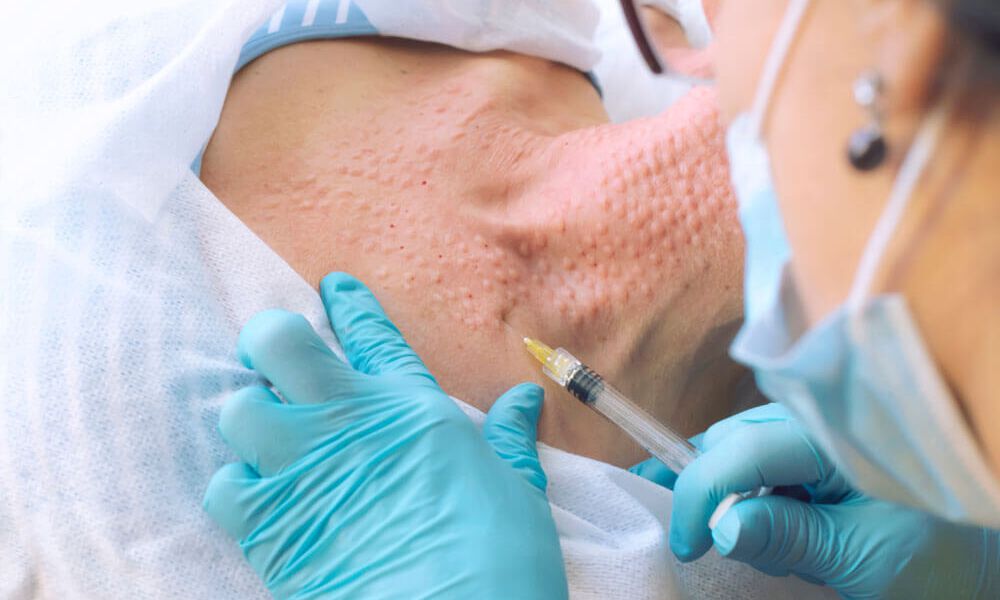 Mesotherapie Mesotherapie